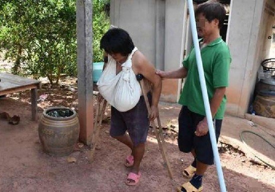 Bà Lam Phrai phải dùng nạng để di chuyển do bộ ngực khổng lồ. Ảnh: Phitsanulok Hot News