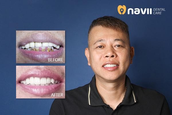 Một ca cấy ghép Implant All on 4 mang lại vẻ đẹp hoàn hảo cho hàm răng tại nha khoa Navii