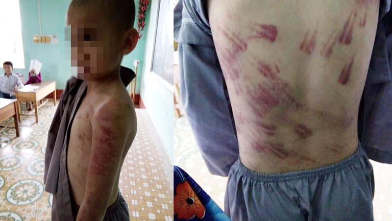 Lãnh đạo huyện Hà Trung lên tiếng vụ học sinh tiểu học bị đánh bầm tím