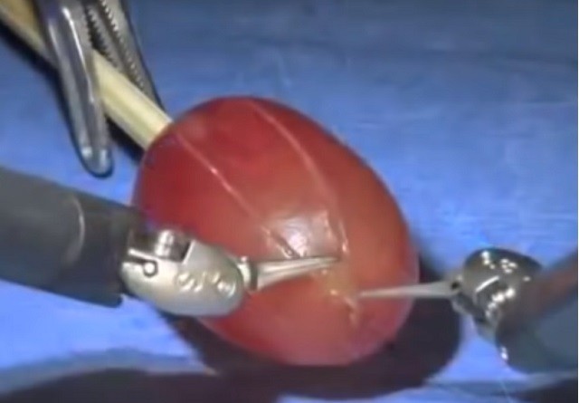 Màn ‘phẫu thuật’ hoàn hảo đến từng milimet của robot