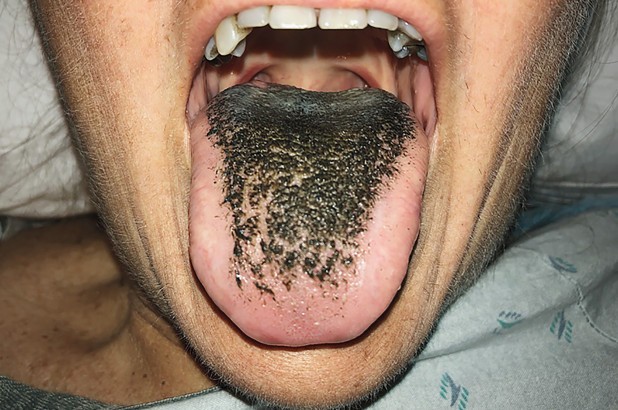 Lưỡi mọc lông có thể là tác dụng phụ của thuốc tây y.