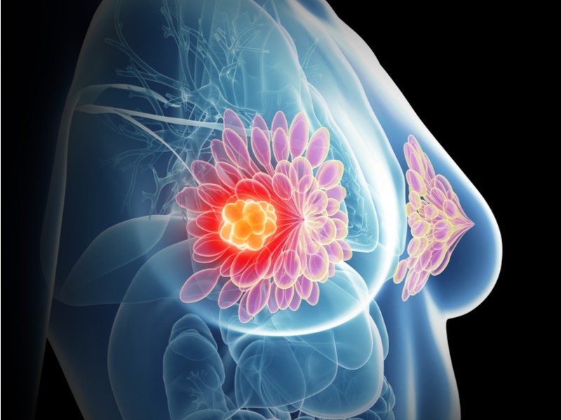 Công cụ trí tuệ nhân tạo mới của Google có thể chẩn đoán ung thư vú tốt hơn cả hình ảnh X.quang.
