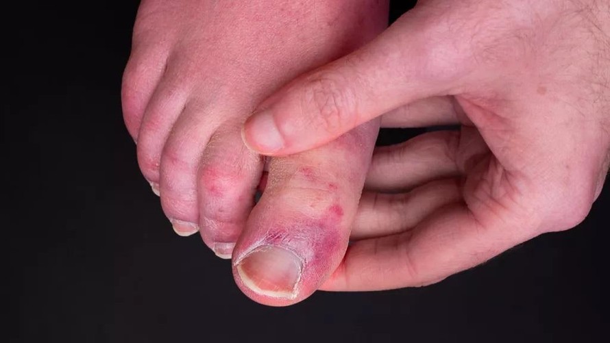 Nhiều người sau khi mắc COVID-19 lại bị phát ban ở ngón chân.