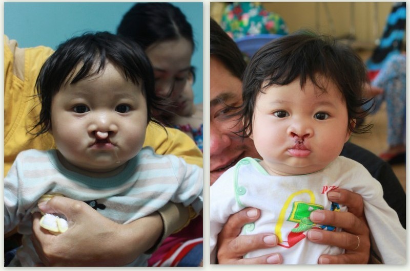 Cháu Khưu Kim Châu trước và sau khi được phẫu thuật. 