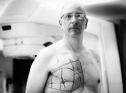 Các bác sĩ đánh dấu lên ngực Bogler để tiến hành hóa trị. Ảnh: David Jay.
