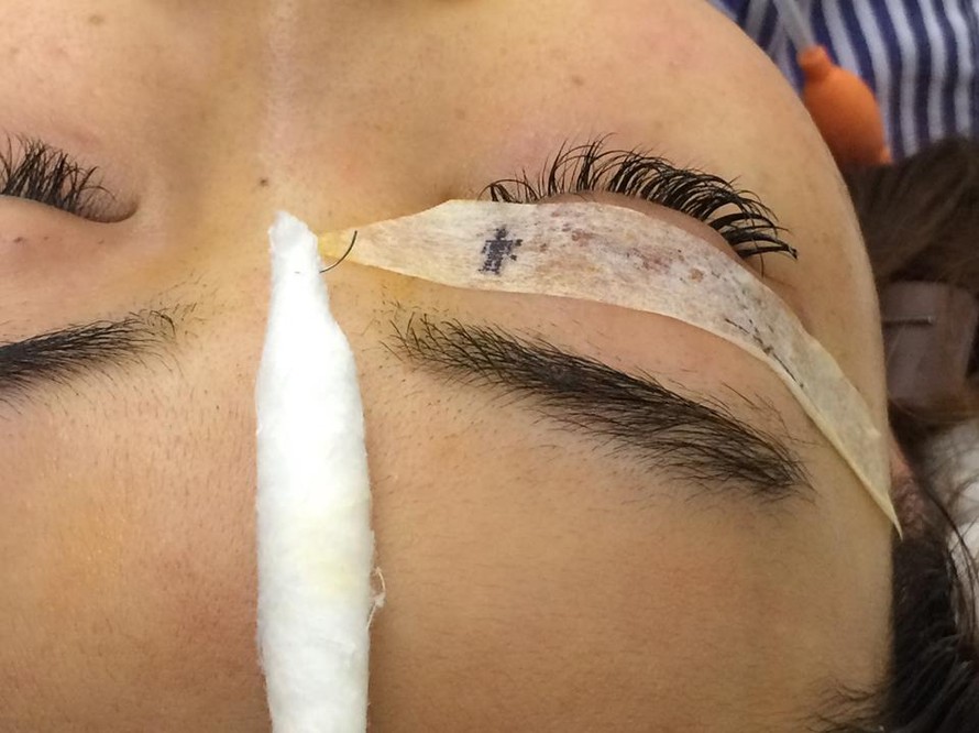 Cây kim phẫu thuật sau khi 'thất lạc' đã được lấy ra khỏi hốc mắt bệnh nhân. 