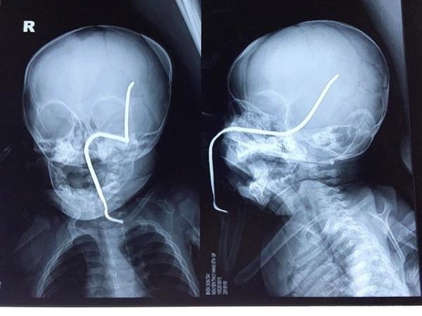 Hình ảnh phim X-quang của cháu H. cho thấy thanh sắt đâm vào gò má trái, xuyên lên vùng não thái dương.