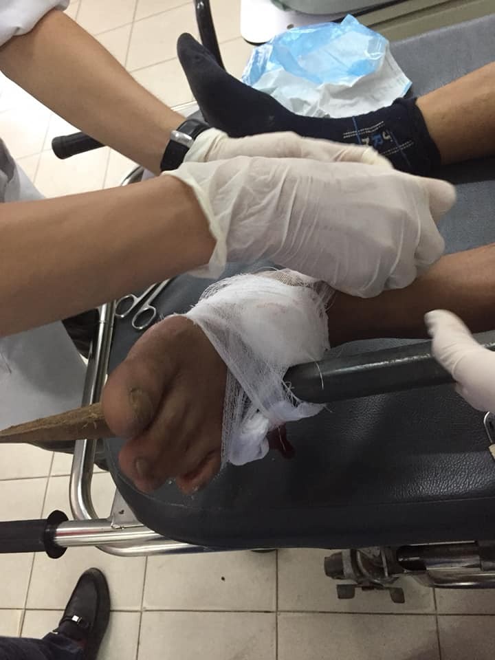 Nam công nhân đến bệnh viện cấp cứu trong tình trạng cây xà beng đâm xuyên thủng bàn chân.
