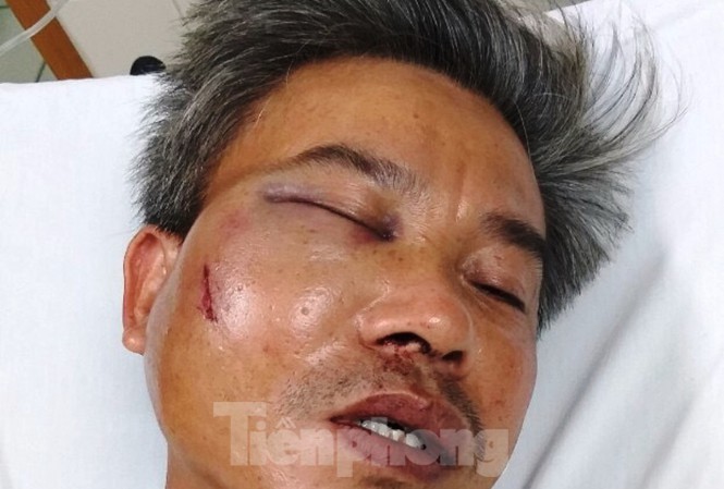 Nạn nhân Lê Song Toàn bị đánh gãy hàm, vỡ xoang, tỷ lệ thương tật 22%.