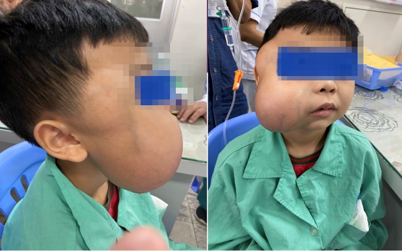 Bé trai bị khối u chiếm trọn khuôn mặt bên phải.