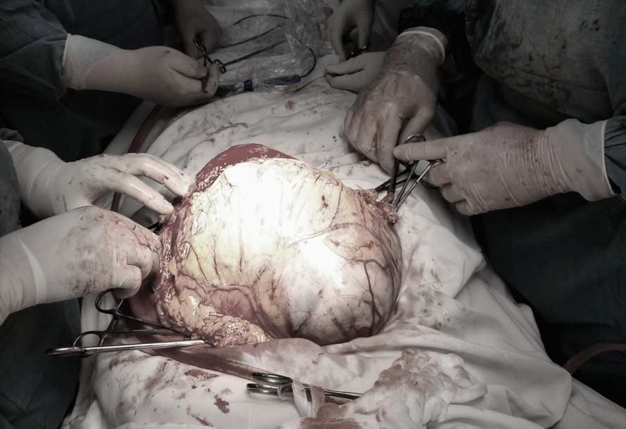 Bác sĩ phẫu thuật cắt khối u 'khủng' cho bệnh nhân.