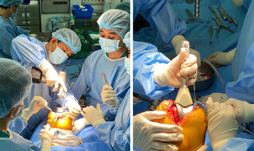 Các bác sĩ phẫu thuật thay khớp gối cho bệnh nhân.