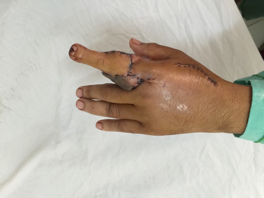 Bàn tay trái bệnh nhân sau khi được ghép ngón chân thay thế ngón trỏ bị cụt. Ảnh do bệnh viện cung cấp.