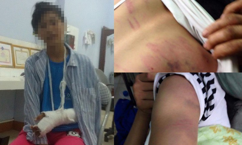 Nữ sinh 15 tuổi bị bố đánh trọng thương, nhập viện