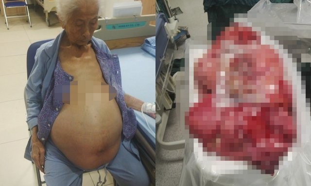 Lấy khối u 13 kg trong bụng bà cụ 100 tuổi