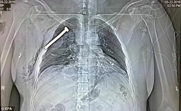 Ảnh X-quang chụp phổi của một nạn nhân sống sót sau vụ khủng bố hôm 22/3. Ảnh: EPA