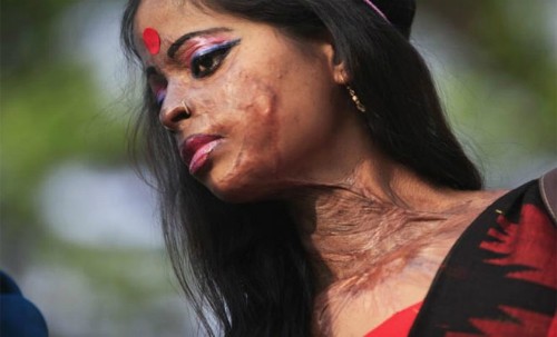 Một nạn nhân bị tạt axit ở Ấn Độ. Ảnh: Indian Express. 