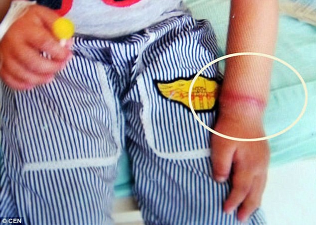 Vệt đỏ trên cổ tay Longlong trước khi phẫu thuật.