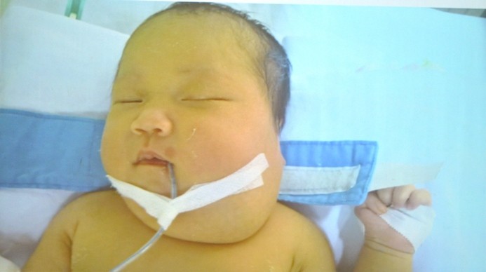 Bé gái bị khối u quái đầu tiên ở Việt Nam trước khi mổ.