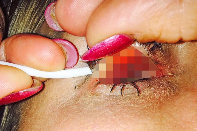 Sử dụng mascara trong thời gian dài đã khiến một người phụ nữ ở Australia suýt bị mù mắt.