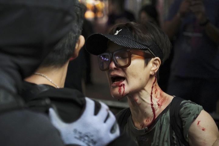 Một người phụ nữ bị thương ở mặt sau khi bị những phần tử bạo loạn tấn công ở Hong Kong. Ảnh: Tân Hoa Xã