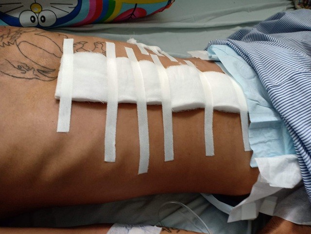 Một nạn nhân khi đang điều trị thương tích tại Bệnh viện Chợ Rẫy - TP Hồ Chí Minh. Ảnh: Gia đình nạn nhân cung cấp 