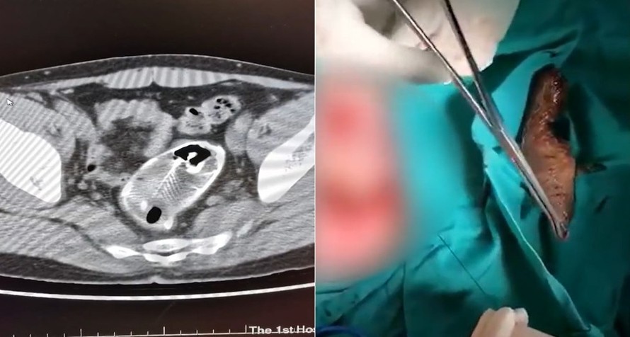 Ảnh chụp X-quang cho thấy chú cá nằm cuộn mình trong đường tiêu hoá của bệnh nhân (trái), và chú cá khi được rút ra ngoài (phải). 