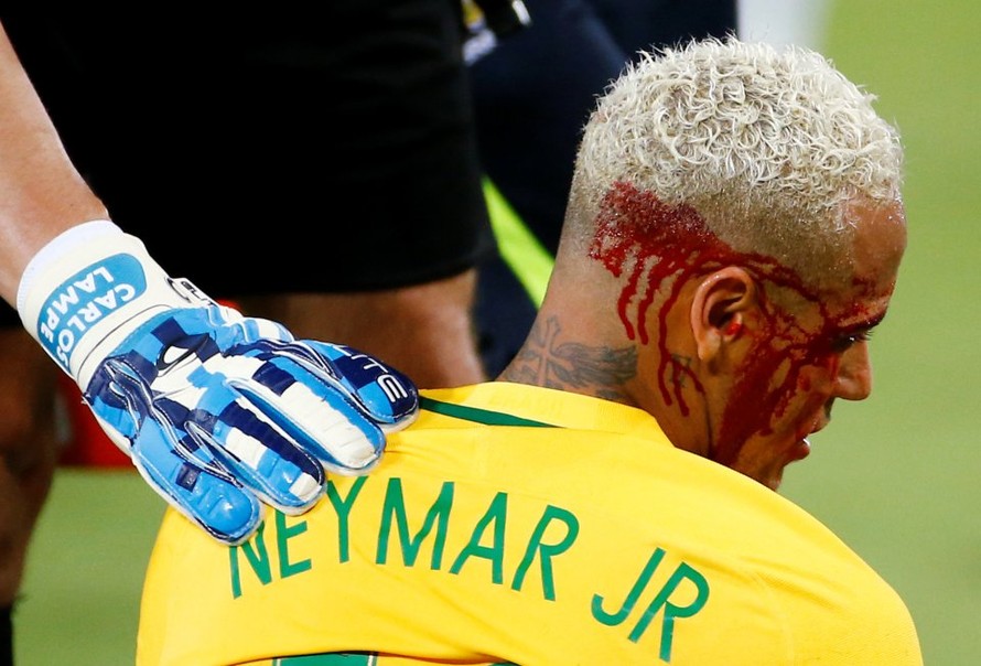 Neymar bị rách mí mắt ở trận đấu với Bolivia.