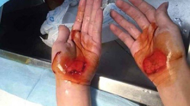 Đôi bàn tay sưng phồng, chảy máu của một học sinh bị phạt. Ảnh: SCMP