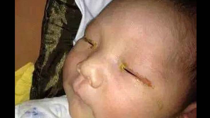 Mắt của bé 3 tháng tuổi bị mù vì chụp ảnh bật đèn flash ở khoảng cách quá gần.
