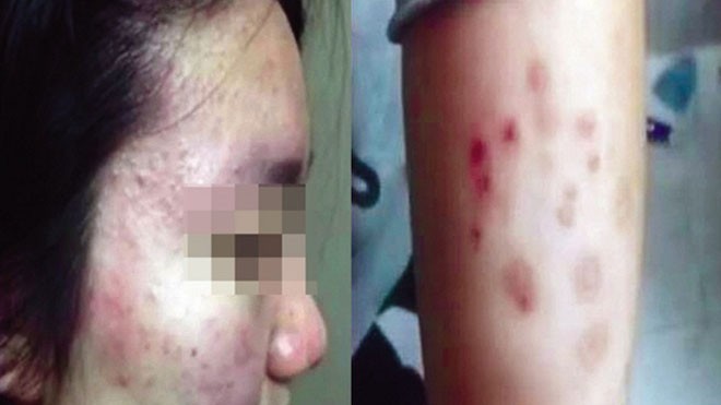 Một học sinh của Trường Ngoại ngữ Thường Châu bị nổi nốt đỏ lạ trên da.