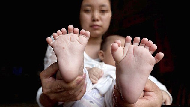 Theo Nhân dân Nhật báo, bé Hồng Hồng 3 tháng tuổi có tới 31 ngón tay và chân, đặc biệt không có ngón tay cái.