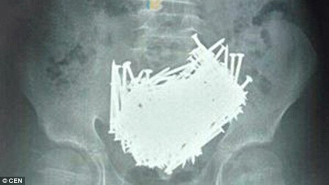Hình chụp CT cho thấy 200 chiếc đinh nằm trong bụng cậu bé 15 tuổi