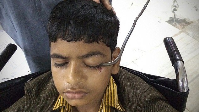Cậu bé Md Baba Qureshi bị móc sắt đâm xuyên mắt và đã được phẫu thuật khẩn cấp để loại bỏ dị vật.