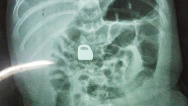 Hình chụp X-quang cho thấy chiếc ổ khóa nằm gọn trong bụng của bé 2 tháng tuổi