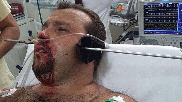 Người đàn ông bị lao sắt đâm xuyên mặt khi mới nhập viện