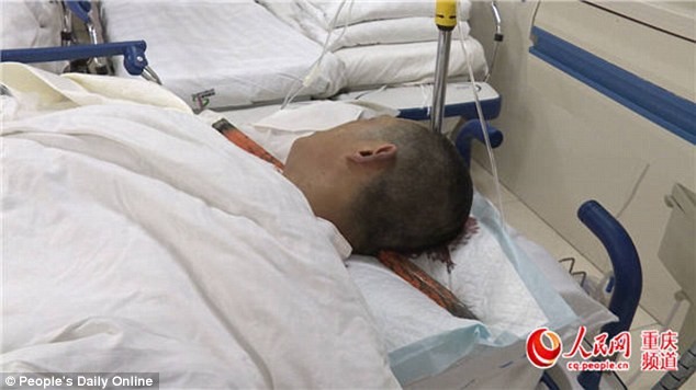 Anh Wang Long bị thanh thép lớn đâm xuyên qua đầu trong một vụ tai nạn lao động.
