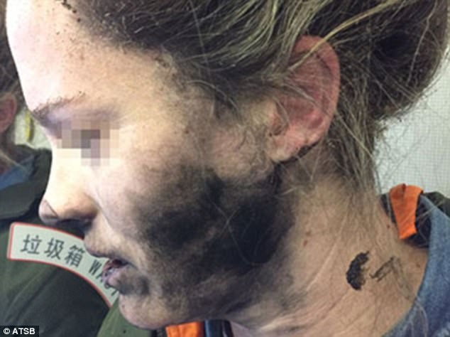 Nữ hành khách bị bỏng mặt, cháy xém tóc vì tai nghe chạy pin phát nổ trên máy bay.