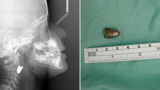 Bức ảnh chụp X-quang và hình ảnh viên đạn sau phẫu thuật (Ảnh: Telegraph)