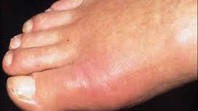 Khớp ngón chân cái bị sưng đỏ do bệnh gút.