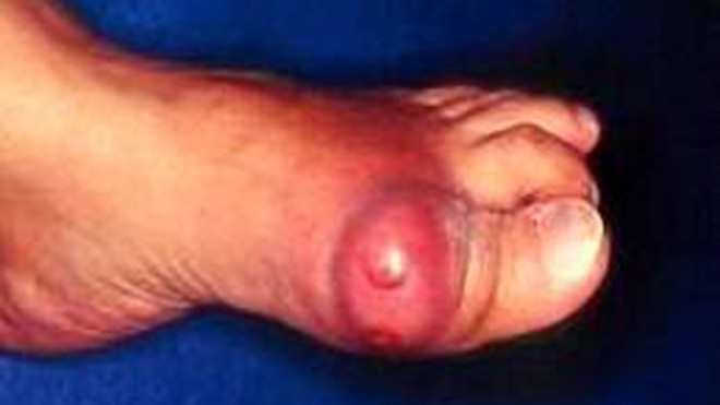 Khớp ngón chân cái là vị trí thường gặp nhất trong cơn gút.