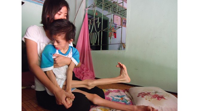 Nhật Lam co quắp tay chân, không thể tự chủ trong mọi sinh hoạt khi bị bại não.