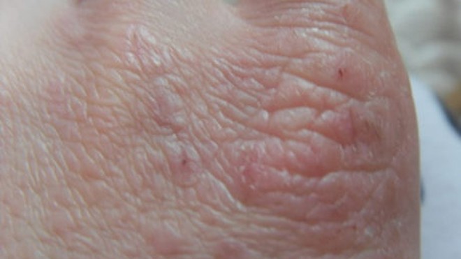 Da của một bệnh nhân bị vẩy nến
