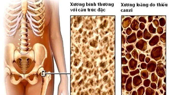 Cấu trúc xương bị loãng – một nguy cơ giảm thính lực