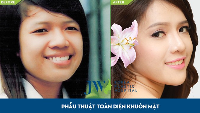 Hot girl Minh Yến là 1 trường hợp điển hình phẫu thuật toàn diện gương mặt, trong đó phương pháp gọt mặt V line do TS. BS. Nguyễn Phan Tú Dung thực hiện.