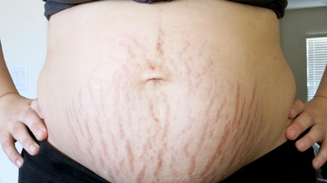 Những vết rạn da rất thường gặp ở phụ nữ mang thai
