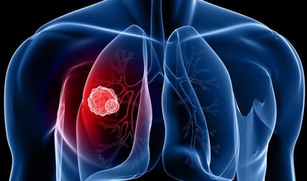 Ung thư phổi: Nguy hiểm cận kề nhưng vẫn có thể sống khoẻ