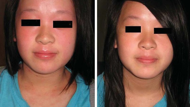 Bé gái 13 tuổi a): Trước khi điều trị bằng các sản phẩm Dr Michaels®, đến khám với tình trạng viêm da dị ứng vùng mặt, cổ và ngực. Các vết cào xước hiển hiện rất rõ ở vùng ngực và còn có phù nề vùng mi mắt và môi, cảm giác bị ngứa kinh khủng. b): Sau 8 tu