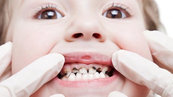 Sâu răng là một trong những nguyên nhân gây mất răng sớm
