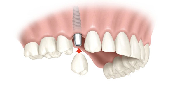 Cấy ghép răng Implant ETK Active có tác dụng thế nào?